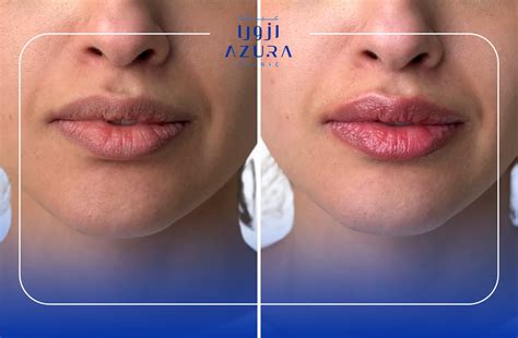 lip glowing   switched laser azura clinic muscat