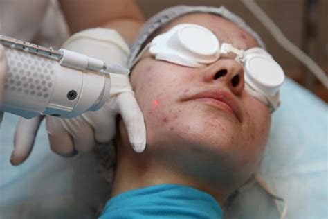 Acne Laser Treatment: Top Acne Treatment Centers In Lebanon.