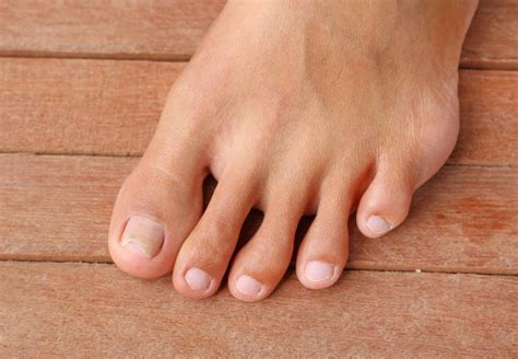 320+ Curved Toenails Stock Photos, Pictures & Royalty-Free Images - iStock