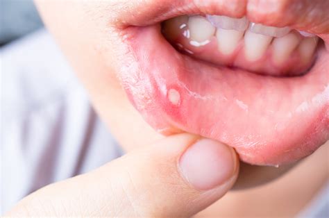 How To Treat A Mouth Infection | Smile Specialists Suite