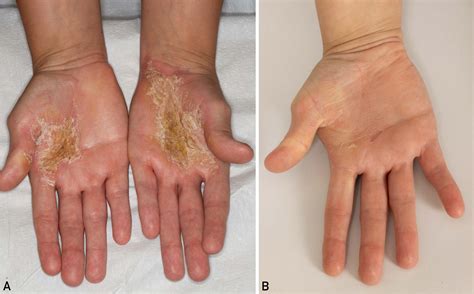 Congenital Keratoderma of Olmsted Syndrome - Mayo Clinic Proceedings