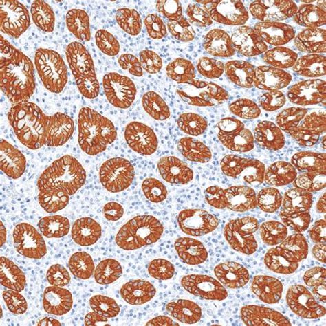 Cancer Diagnostic Antibody and Protein,Pathological Diagnostic Reagent ...