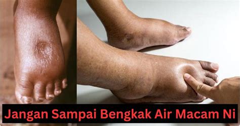 bengkak air disebabkan kegagalan fungsi buah pinggang triple