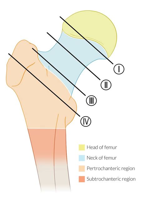 Intertrochanteric Fracture Vs Femoral Neck Fracture