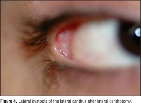 structure  canthus semantic scholar