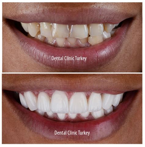Porcelain Veneers - Porcelain Veneers Turkey | Dental Clinic Turkey
