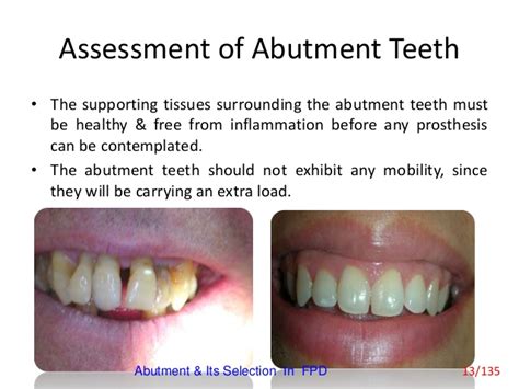 Abutment Teeth - Dental News Network