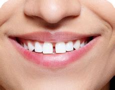 Элайнеры Invisalign в Краснодаре - Выгодные цены в Dr. Shumaev