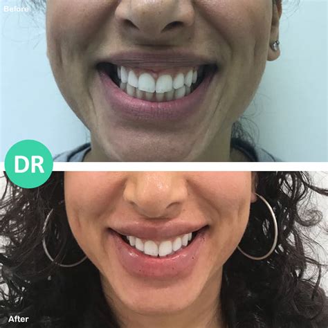 treating gummy lines dr aesthetica