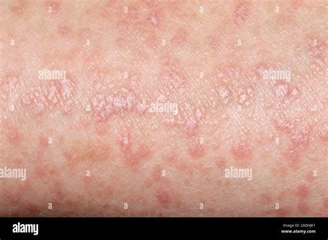 lichen planus disease close    skin    year  woman