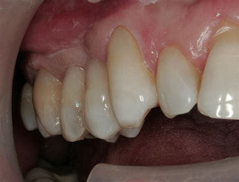 Tooth Abfraction Treatment