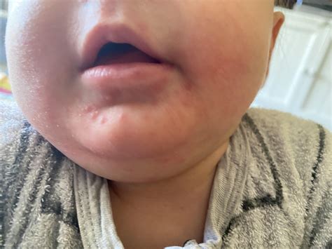 Are these baby cold sores? : r/newborns