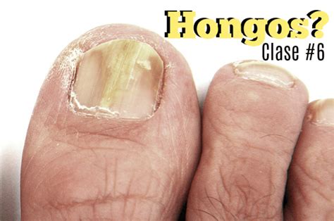 hongos en las uñas – DEKO UÑAS