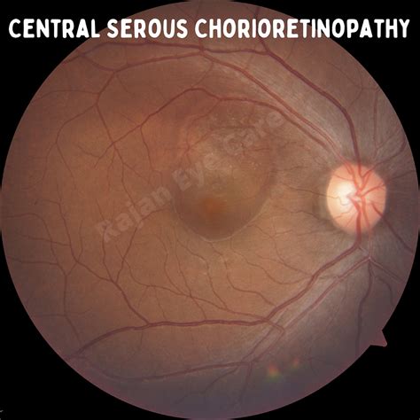 Central Serous Chorioretinopathy!