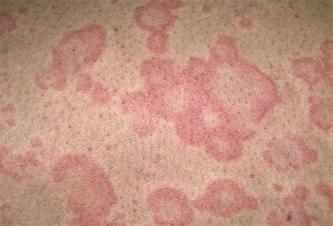 pictures  common adult skin problems identify rashes eczema