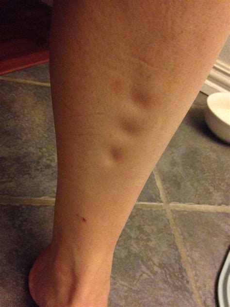 Not again! Pitting Edema Vent — The Bump