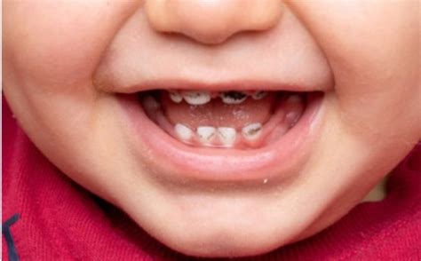 Baby teeth development and toddler teeth - Blog