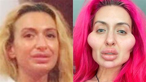 Maçãs Do Rosto Proeminentes - Cenapop · Mulher com as maiores maçãs do rosto do mundo mostra antes e ...