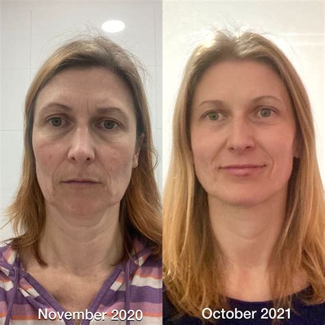 face fitness coach  face yoga therapist