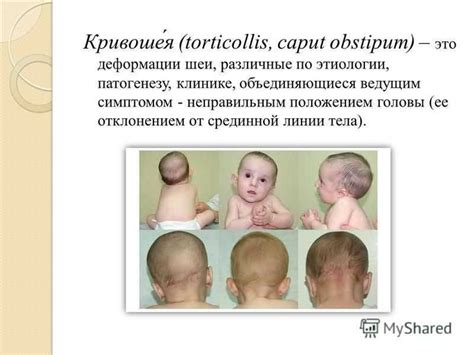 Кривошея у грудничка. симптомы, лечение патологии