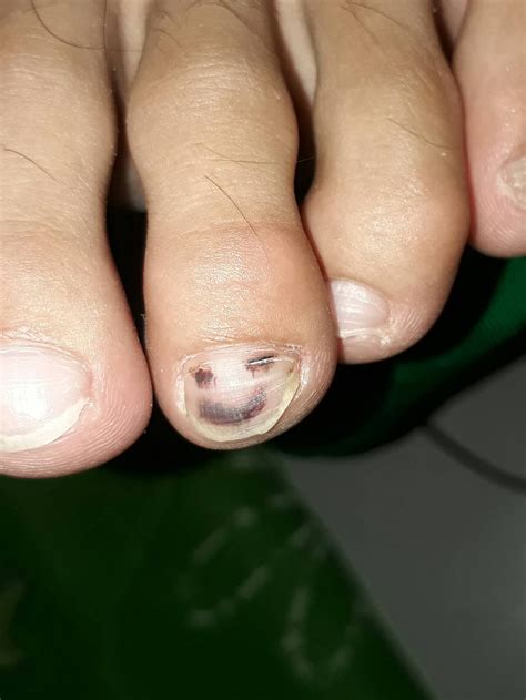 Accidentally jammed my toe under a door. This is what it looks like