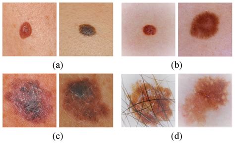 Nodular Malignant Melanoma