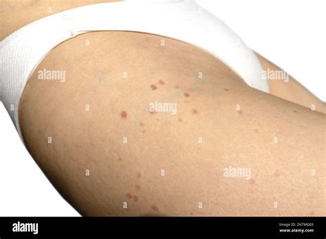 burns from laser hair removal. Burn spots from laser skin treatment for ...