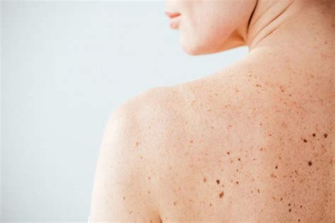 The Dangers of DIY Mole Removal : Skin Cancer Specialists: Dermatologists