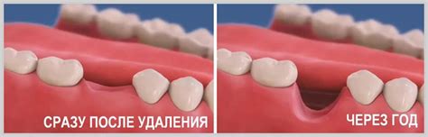 Когда после удаления зуба можно ставить имплант?