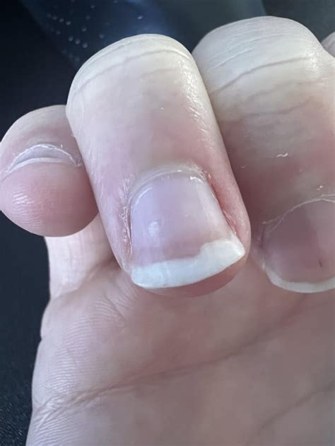 dont pick   skin   nail  idea
