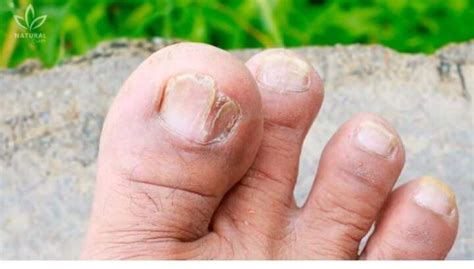 Мон Зар | 👣 Арьс, хумсны мөөгөнцөрийг эмчлэх тос🤗 📲89910866