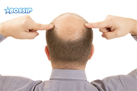 A Gallery Of Balding Men Who Refuse To Let Their Hair Go