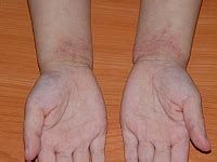 tradzik noworodkowy  niemowlecy pediatria medycyna praktyczna dla