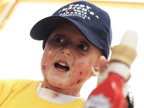Diseases: Eb Skin Disease