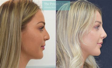 types  nose shapes  images nose types female  type  nose