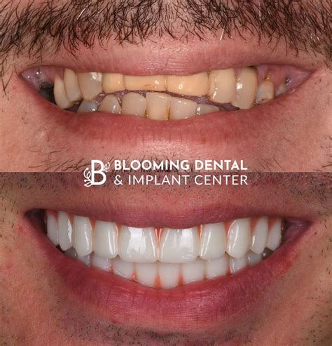 Before & After Photos | Blooming Dental & Implant Center | West ...