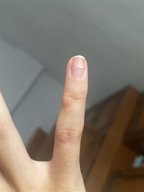 Growing bump on fingerjoint : r/DiagnoseMe