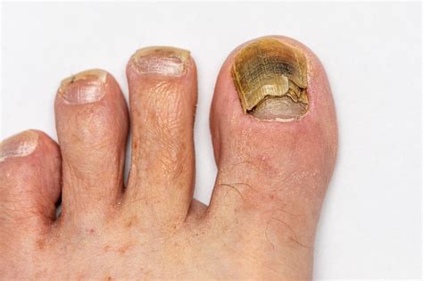 Why Does Toenail Fungus Smell?