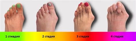 Поперечное плоскостопие – симптомы, лечение, фото