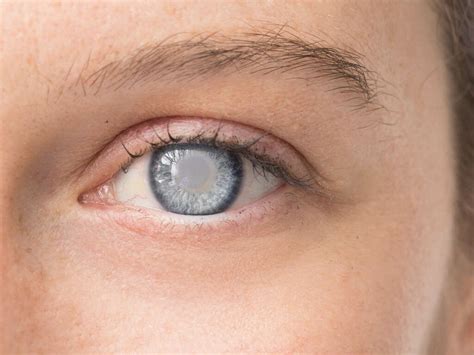 Double Vision: 10 Common Causes of Double Vision