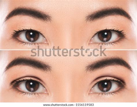 72 Asian Eyelid Blepharoplasty Treatment Images, Stock Photos, 3D ...