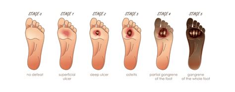 What is an ulcer, types of ulcers, their causes, symptoms and treatment ...