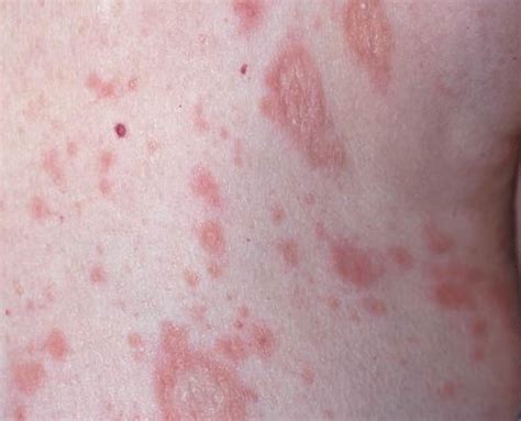Pityriasis Rosea Histology | Pityriasis rosea – DKRISP