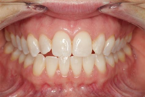 tmd anterior open bite tendency problems occlusion connections