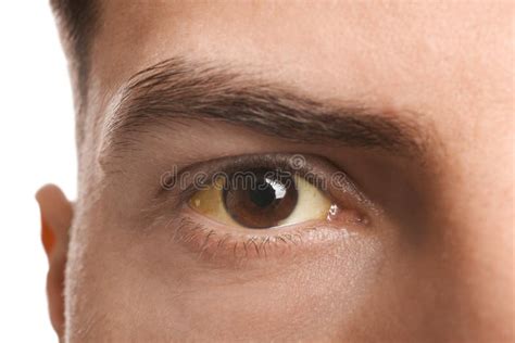 Man with Yellow Eyes on White Background, Closeup. Liver Problems ...