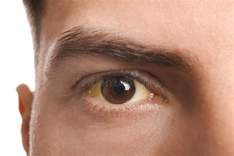 Man with Yellow Eyes on White Background, Closeup. Liver Problems ...