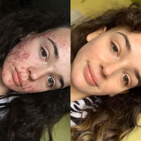 Accutane Before and After: 9 Women on Their Isotretinoin Side Effects