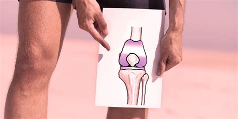 Knee Replacement Alternatives to Avoid Surgery in 2020 - Dr. Lox