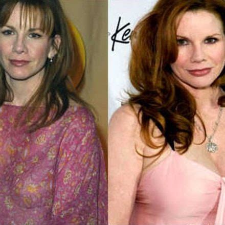 Inside Information On Melissa Gilbert Plastic Surgery