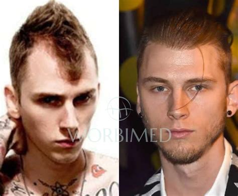 (MGK) Machine Gun Kelly Hair Transplant